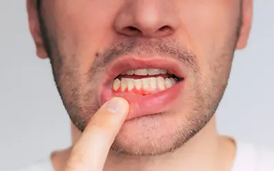 periodontitt loren torg tannlegesenter thumb¨