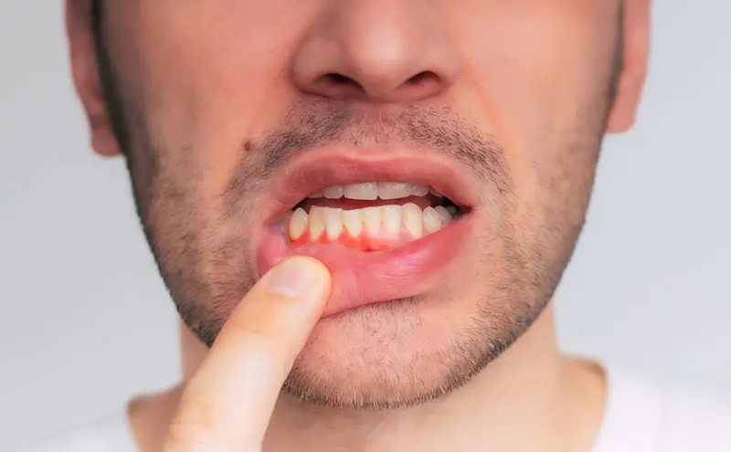 periodontitt-loren-torg-tannlegesenter periodontitt loren torg tannlegesenter